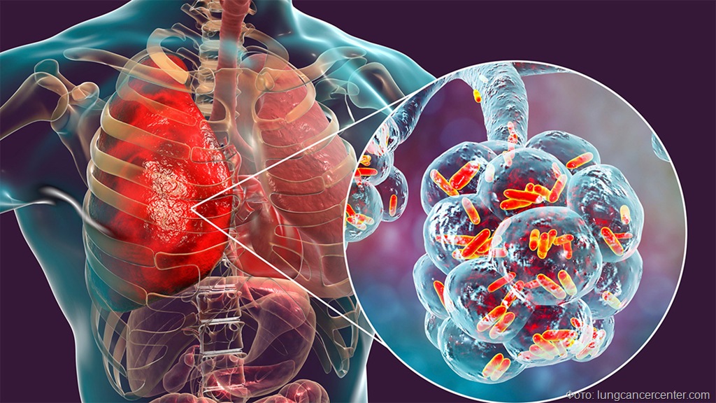 Грипп и ОРВИ наступают: как пережить вирусный сезон без осложнений
